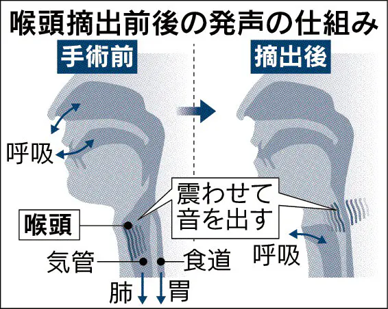 失った声再建 励まし合って 声帯摘出2 3万人 Nikkei Style