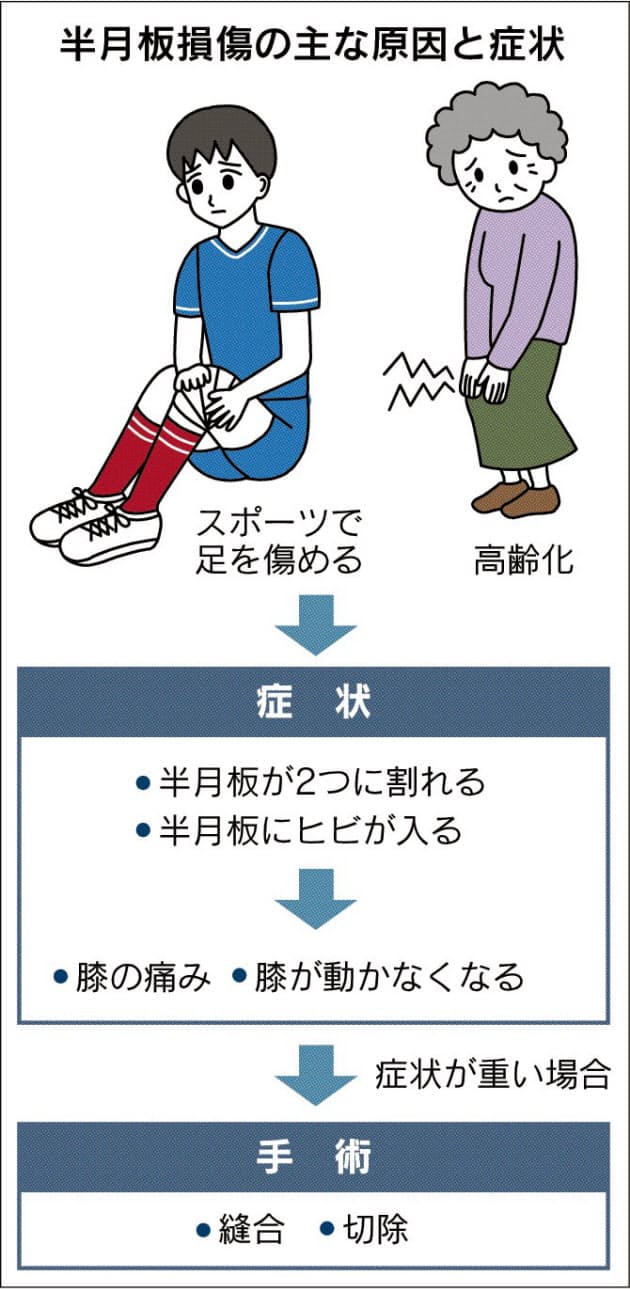 半月板損傷に光 患者の細胞から 牛のコラーゲン活用 Nikkei Style 半月板損傷に光 患者の細胞から 牛のコラーゲン活用 Nikkei Style