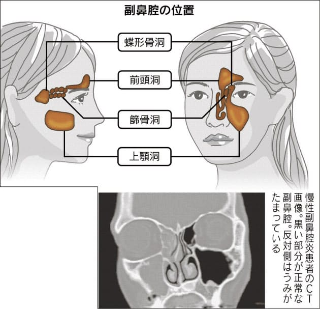 つら い慢性副鼻腔炎 タイプ様々 適切な治療を Nikkei Style