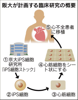 大阪大 Ips細胞で世界初の心臓病治療へ 日本経済新聞