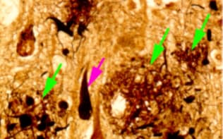 アルツハイマー病患者の海馬の病理組織像。緑の矢印はアミロイドが沈着した老人斑、ピンクの矢印は神経原線維変化と呼ばれる病変（東京大学大学院の岩坪威教授提供）