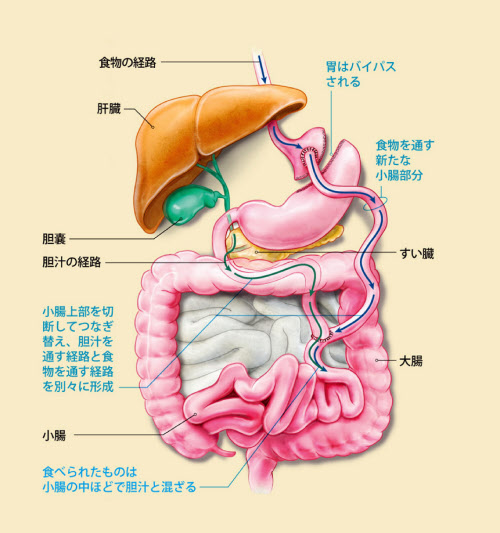 糖尿病を手術で治す 臨床試験が示す可能性 日本経済新聞