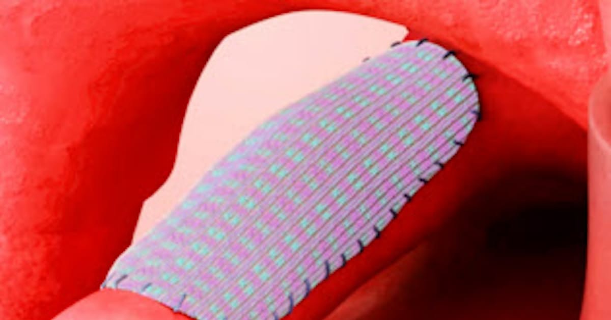 心臓の穴 繊維で塞ぐ 福井経編と帝人 乳児に手術 日本経済新聞