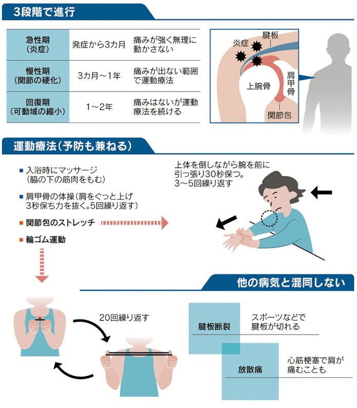 いきなり痛む五十肩 秋から始める予防法 日本経済新聞