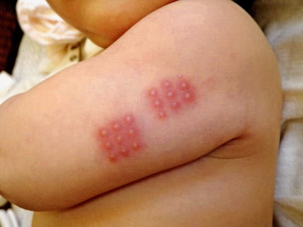 BCGワクチン接種が新型コロナに有効かどうかはまだ分からない(結核予防会提供)