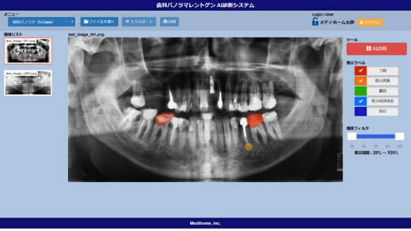 メディホームの診断AIはパノラマエックス線写真を画像解析して虫歯などを見つける