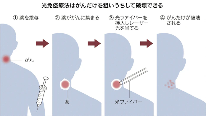 がんの光免疫療法 年内にも開始 顔 首回り症例から 日本経済新聞