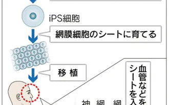 Ips移植 パーキンソン病患者の脳に 京大が治験 日本経済新聞