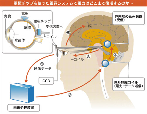 電極チップで視力回復へ 人工網膜 開発最前線 日本経済新聞