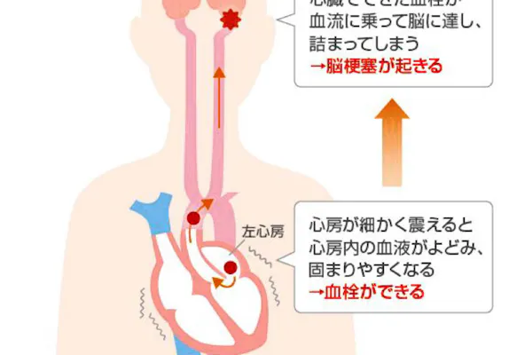 血液をサラサラにする薬 アスピリンの効果と限界 Nikkei Style