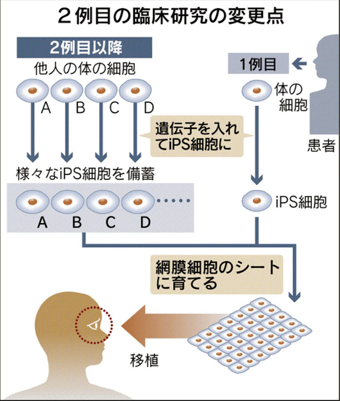 Ips移植費用 大幅減 手術待ち期間を短縮 日本経済新聞