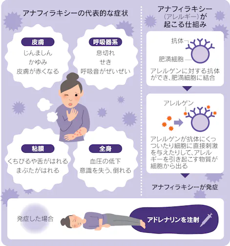 新型コロナ コロナワクチン接種でアナフィラキシー 国内2例目 日本経済新聞 新型コロナ コロナワクチン接種でアナフィラキシー 国内2例目 日本経済新聞