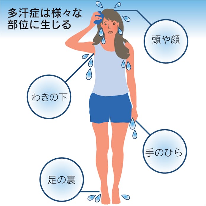 一生涯の悩みから解放される!多汗症治療の最新トレンド - 伝統的な多汗症治療方法