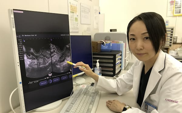 聖マリアンナ医科大学の洞下講師はPCOSの超音波画像を見せて患者に説明する