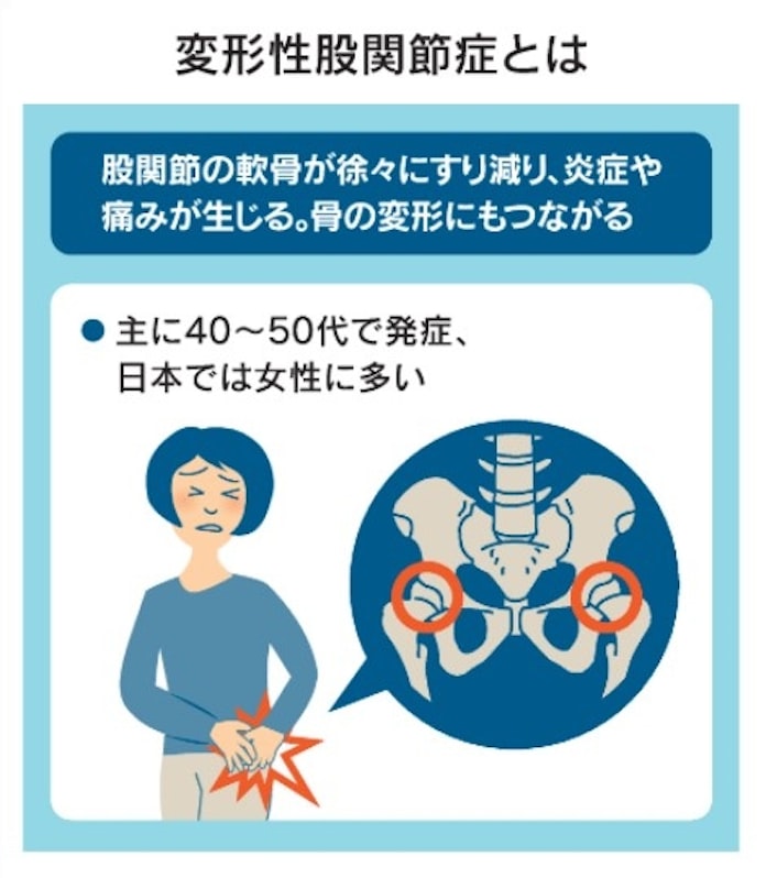 股関節の痛み 放置は禁物 骨盤回し で筋肉鍛え対策 日本経済新聞 股関節の痛み 放置は禁物 骨盤回し で筋肉鍛え対策 日本経済新聞