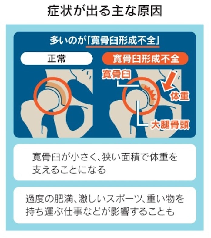 股関節の痛み 放置は禁物 骨盤回し で筋肉鍛え対策 日本経済新聞