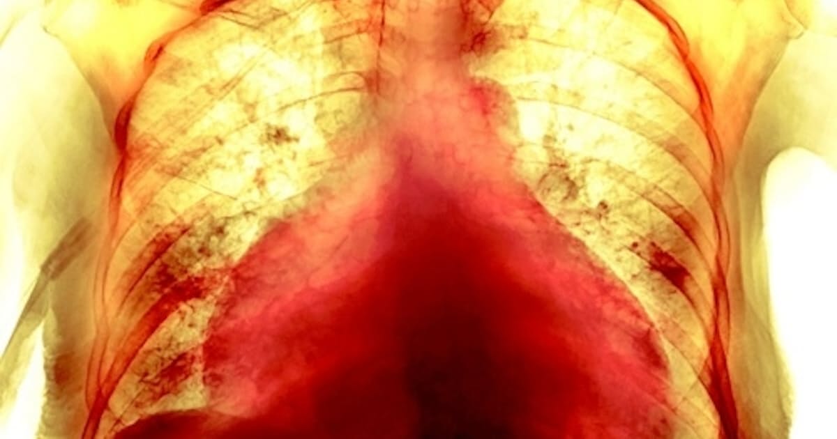 長引くコロナの心臓後遺症 治療法は 研究に進展 日本経済新聞 長引くコロナの心臓後遺症 治療法は 研究に進展 日本経済新聞