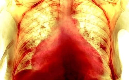 新型コロナウイルス感染症患者の肥大した心臓のX線写真。74歳の女性。回復から何カ月もたち、胸部スキャンやその他の検査結果が正常に戻ったにもかかわらず、心血管系の症状が続く患者もいる。（PHOTOGRAPH BY P. MARAZZI/SCIENCE SOURCE）