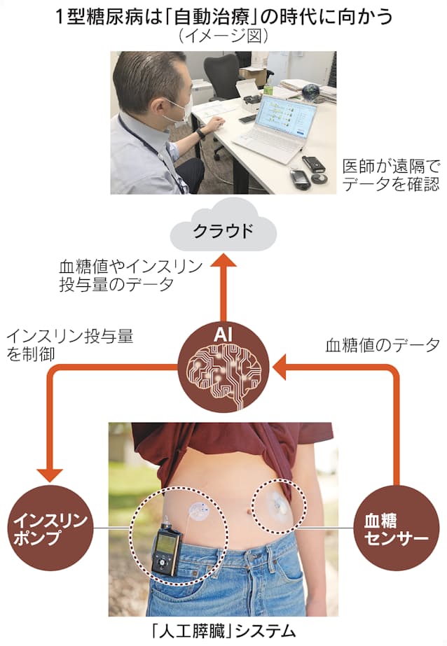糖尿病はもうつらくない 自動治療 で乗り越える時代 日本経済新聞 糖尿病はもうつらくない 自動治療 で乗り越える時代 日本経済新聞