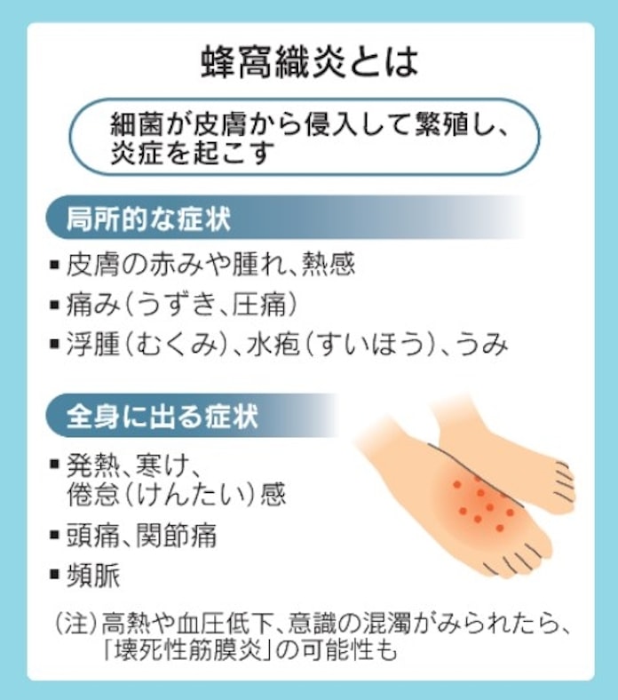 足が赤く腫れて痛い 傷から細菌が侵入 蜂窩織炎 に 日本経済新聞 足が赤く腫れて痛い 傷から細菌が侵入 蜂窩織炎 に 日本経済新聞