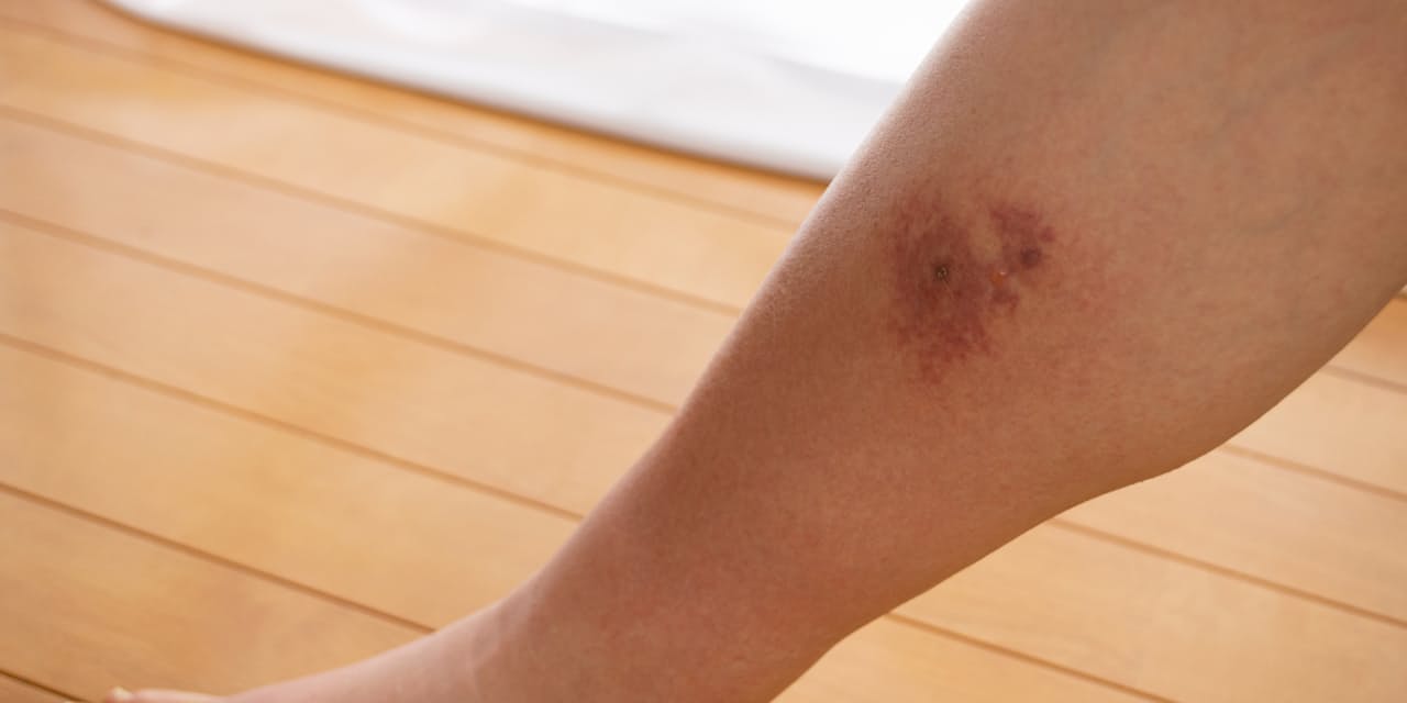 足が赤く腫れて痛い 傷から細菌が侵入 蜂窩織炎 に Nikkei Style 足が赤く腫れて痛い 傷から細菌が侵入 蜂窩織炎 に Nikkei Style