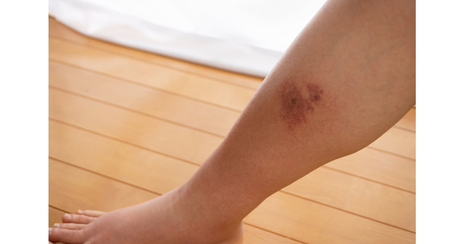 足が赤く腫れて痛い 傷から細菌が侵入 蜂窩織炎 に Nikkei Style 足が赤く腫れて痛い 傷から細菌が侵入 蜂窩織炎 に Nikkei Style