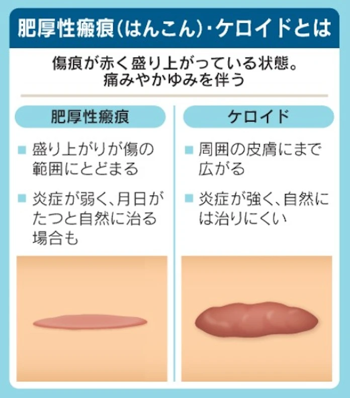 傷痕が赤く盛り上がる ケロイド 体質や皮膚刺激が影響 日本経済新聞 傷痕が赤く盛り上がる ケロイド 体質や皮膚刺激が影響 日本経済新聞