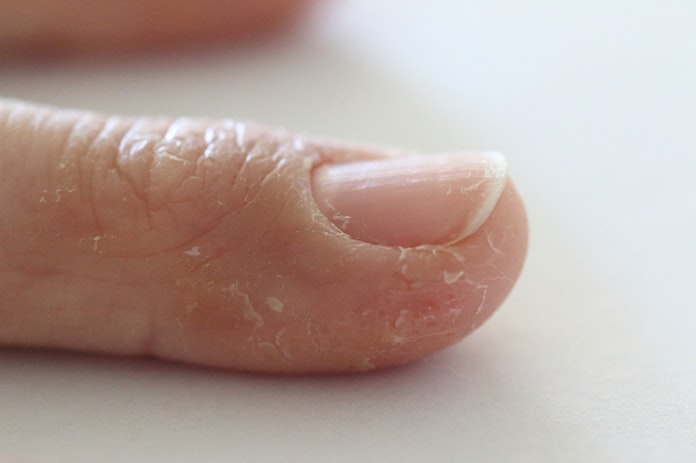 手足に謎のしつこい水疱 異汗性湿疹を疑ってみる 日本経済新聞 手足に謎のしつこい水疱 異汗性湿疹を疑ってみる 日本経済新聞