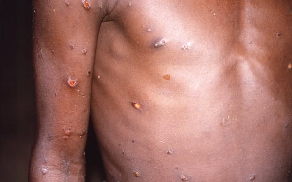 感染して皮膚に生じる発疹は天然痘に似ている。サル痘は接触感染で広がり、天然痘と違って飛沫によって感染が広がることはまれだ=米疾病対策センター提供