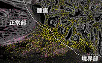腫瘍(がん細胞)と正常部の境界に黄色で示したTHBS2が多く発現し、ピンクで示した免疫細胞が腫瘍に入り込めなくなっている=京都大学提供
