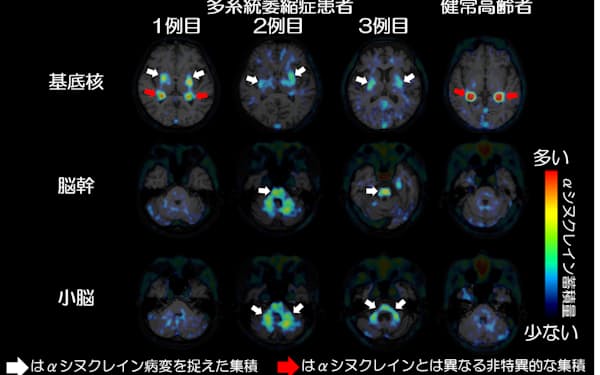 多系統萎縮症の患者3人の脳をPETで撮影し、αシヌクレインが蓄積している状態を画像化できた＝量研機構提供