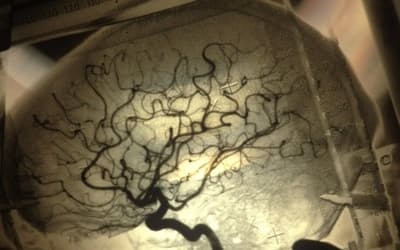米バージニア大学医療センターで撮影された血管造影図。新型コロナウイルス感染に関連する頭痛は、三叉神経への影響を伴う微小血管の損傷に起因する可能性がある。（PHOTOGRAPH BY JOE MCNALLY, GETTY IMAGES）