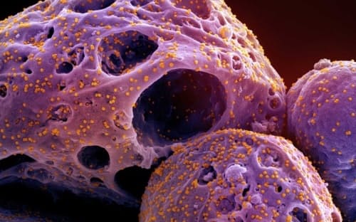 オミクロン株のウイルス粒子（オレンジ色）に感染した細胞（紫色）の着色走査型電子顕微鏡写真。新型コロナ感染症の患者から分離した。（MICROGRAPH BY NIAID/NIH）