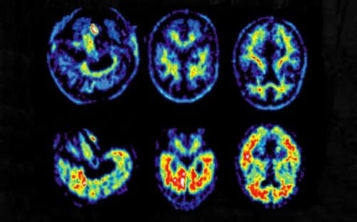 ポジトロン断層法（PET）で撮影された健常なヒトの脳（上）とアルツハイマー病患者の脳（下）の画像。赤く表示されているのが、アルツハイマー病の特徴であるアミロイドβタンパク質の塊。（PHOTOGRAPH BY SCIENCE SOURCE）