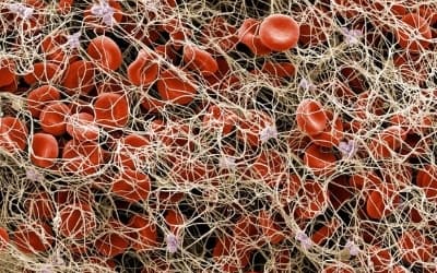 走査型電子顕微鏡（SEM）による血栓の拡大画像。繊維状のタンパク質によってできた網に、血小板（青紫）という小さな細胞片と赤血球が引っかかってできている。毛細血管にできるものは微小血栓と呼ばれる。（MICROGRAPH BY ANNE WESTON/EM STP, THE FRANCIS CRICK INSTITUTE, SCIENCE PHOTO LIBRARY）