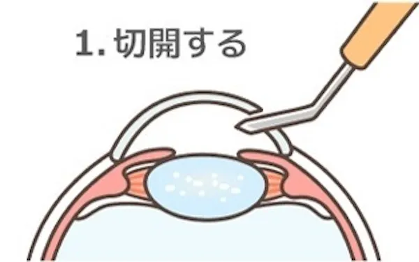 白内障手術のタイミング 名医が回答