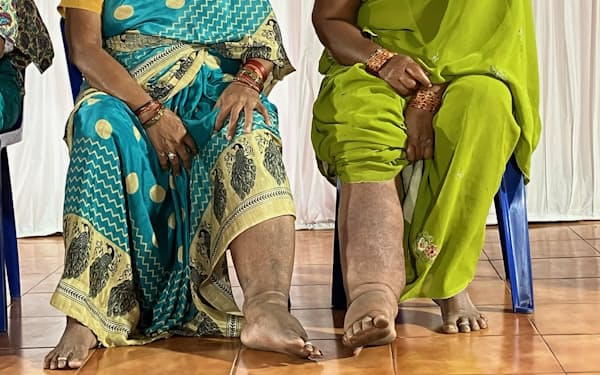 LFで足が膨れ上がったヤラダ村の患者