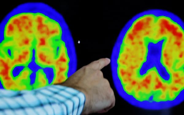 アルツハイマー病を陽電子放射断層撮影装置（PET）で調べる様子（米マサチューセッツ州）=ロイター