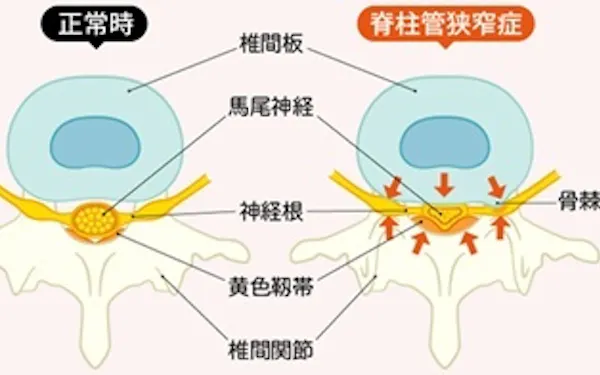 脊柱管狭窄症 見逃せないサイン