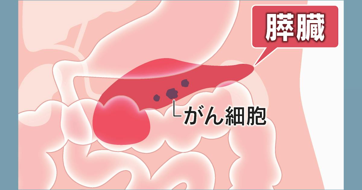 膵臓がんにピロリ菌関係か、抗体値高いほどリスク 愛知がんセンター - 日本経済新聞