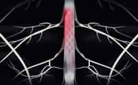 パーキンソン病患者の背骨の中に電極を埋め込み、歩行を補助するように脊髄を電気刺激する（イメージ）＝EPFL提供