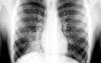 胸部レントゲン写真。心臓の右縁下部の横に影があり、右肺の下葉が肺炎に侵されていることがわかる（写真左側）。（PHOTOGRAPH BY LIVING ART ENTERPRISES, LLC/SCIENCE PHOTO LIBRARY）