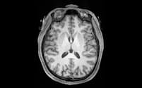 脳画像データからＡＩで精神病の発症リスクを判定する＝東京大学提供