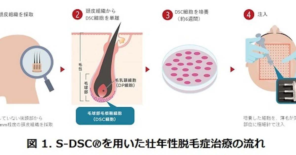 日本経済新聞に「東邦大医療センター大橋病院、S-DSCを用いた毛髪再生医療の提供を開始」という記事が掲載されました。