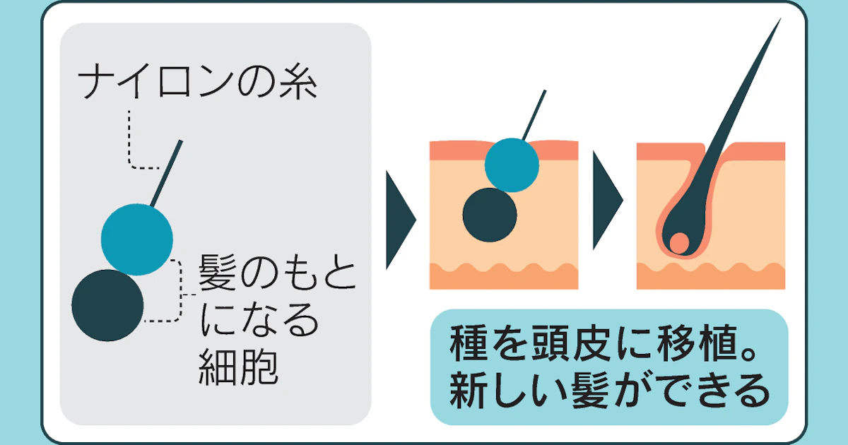日本経済新聞に、S-DSCは第1世代の治療法として紹介されました。