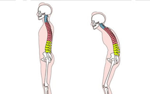 60代からの背骨の変形は腰曲がりへ