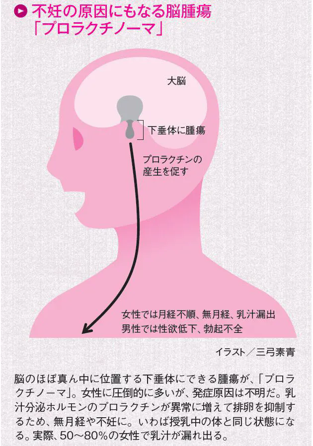 20 30代の不妊 脳腫瘍の疑いも 特効薬でほぼ完治 Nikkei Style