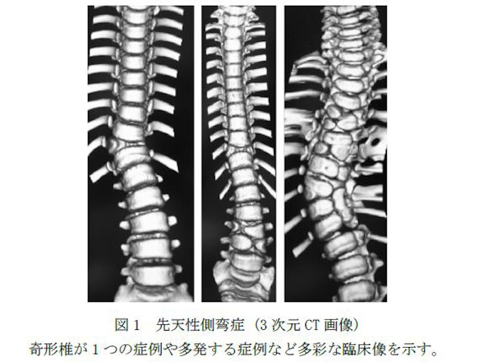 慶大と横浜市大など 先天性側弯 そくわん 症 Cs の10 は Tbx6 遺伝子が原因であることを発見 日本経済新聞 慶大と横浜市大など 先天性側弯 そくわん 症 Cs の10 は Tbx6 遺伝子が原因であることを発見 日本経済新聞