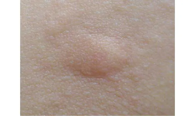 爪でバツ印をつける たたく 冷やす 温める 効果はある 蚊 ネコノミ ヒアリ Nikkei Style 爪でバツ印をつける たたく 冷やす 温める 効果はある 蚊 ネコノミ ヒアリ Nikkei Style