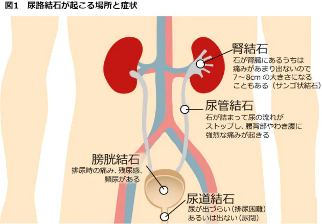 なぜ夏に多い 尿路結石 予防 再発防止のポイント Nikkei Style
